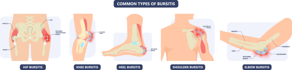 Bursitis