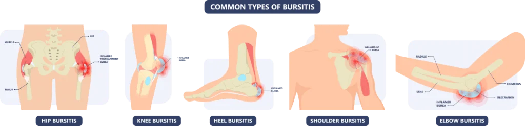 Bursitis