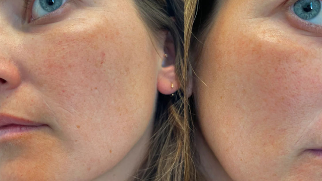 Erase Broken Capillaries with Precision Laser Treatment Unveiled