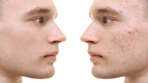 Rosacea-Flecken mit innovativer Lasertherapie beseitigen