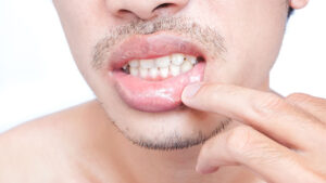 Laserbehandlung - der schlimmste Albtraum eines Lippenherpes