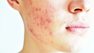 Verwandeln Sie Ihre Haut mit Lasertherapie zur Linderung von Rosacea
