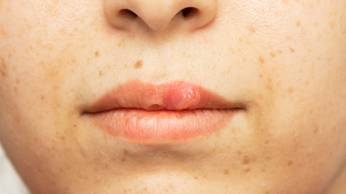 Laser Precision for Cold Sore Comfort