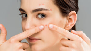 Lasertherapie bei Rosacea Glow