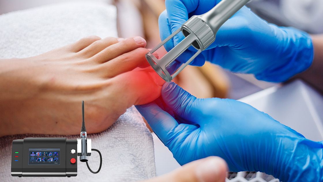 Laser Toenail Fungus Treatment