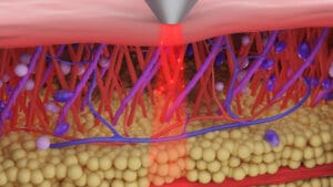 Terapia láser de clase 4
